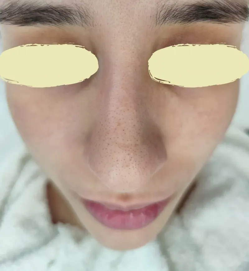 Nariz y mejillas de una paciente antes y después de la limpieza facial: poros visiblemente más limpios (antes)