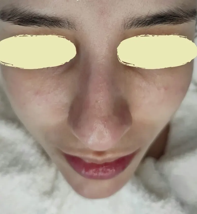 Nariz y mejillas de una paciente antes y después de la limpieza facial: poros visiblemente más limpios (después)