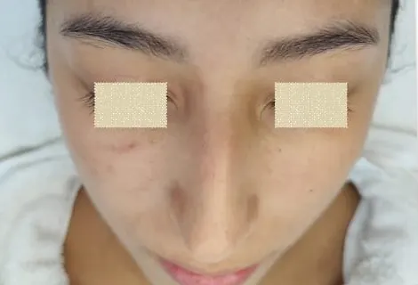 Rostro de una paciente con los ojos tapados, antes