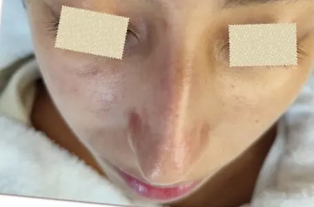 Rostro de una paciente con los ojos tapados, después